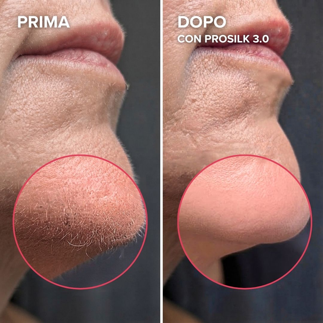 ProSilk 3.0 | Epilatore Viso